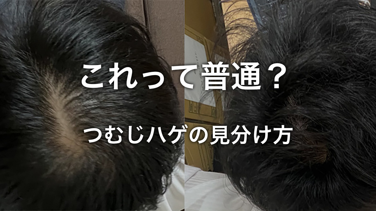 つむじハゲの見分け方